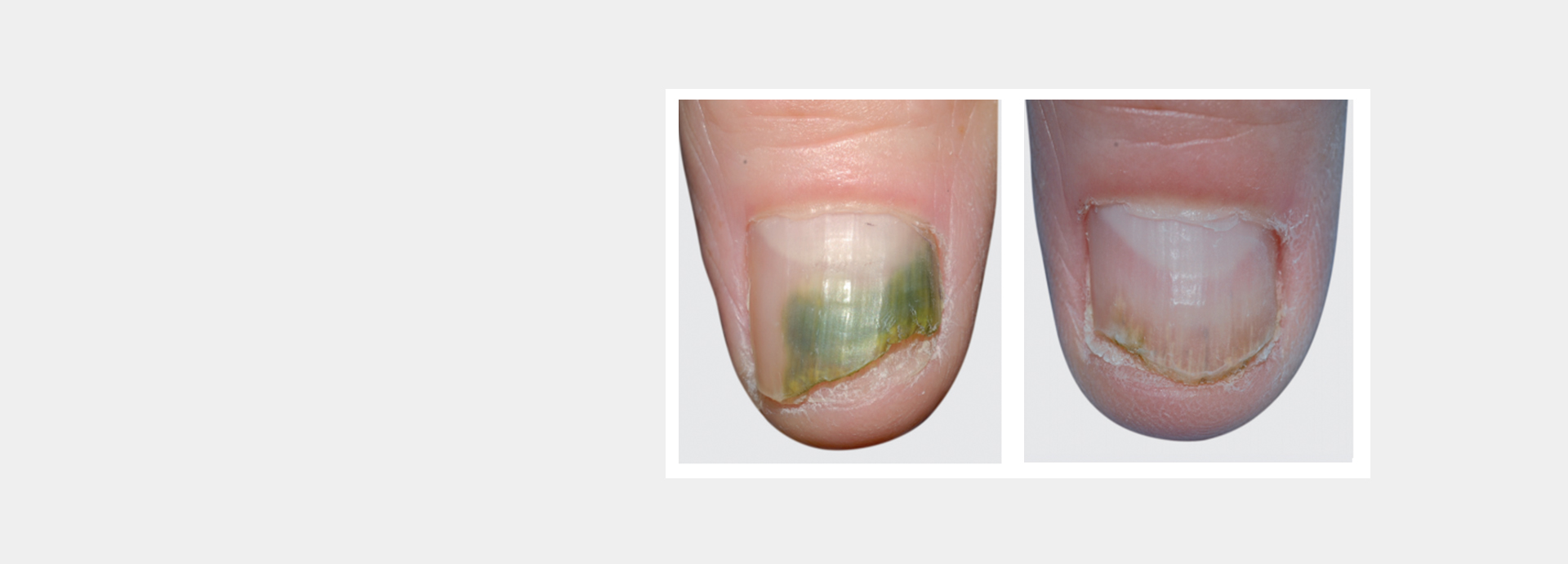 Green Nail Syndrome - What is GNS? How to treat and prevent? – LÓA NAILS